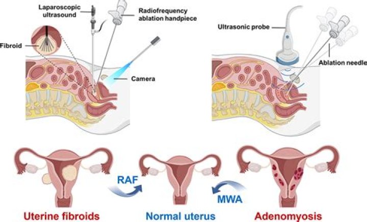 Are you awake for uterine ablation?