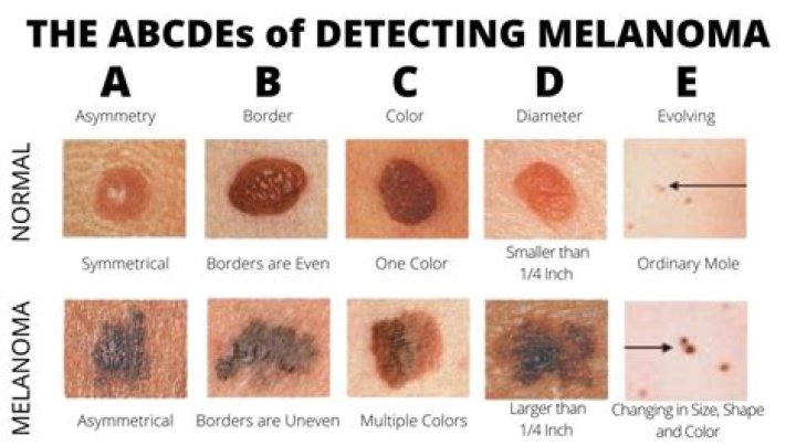 Can a melanoma appear overnight?