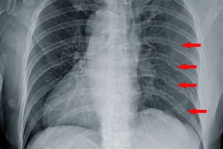 Can airbags break ribs?