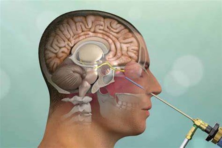 Can an ENT detect CSF leak?