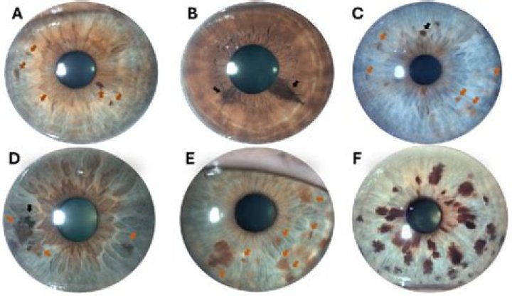 Can eye freckles appear suddenly?
