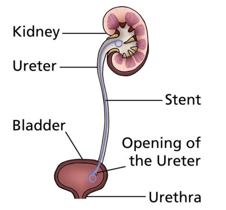 Can you put a stent in the Widowmaker?