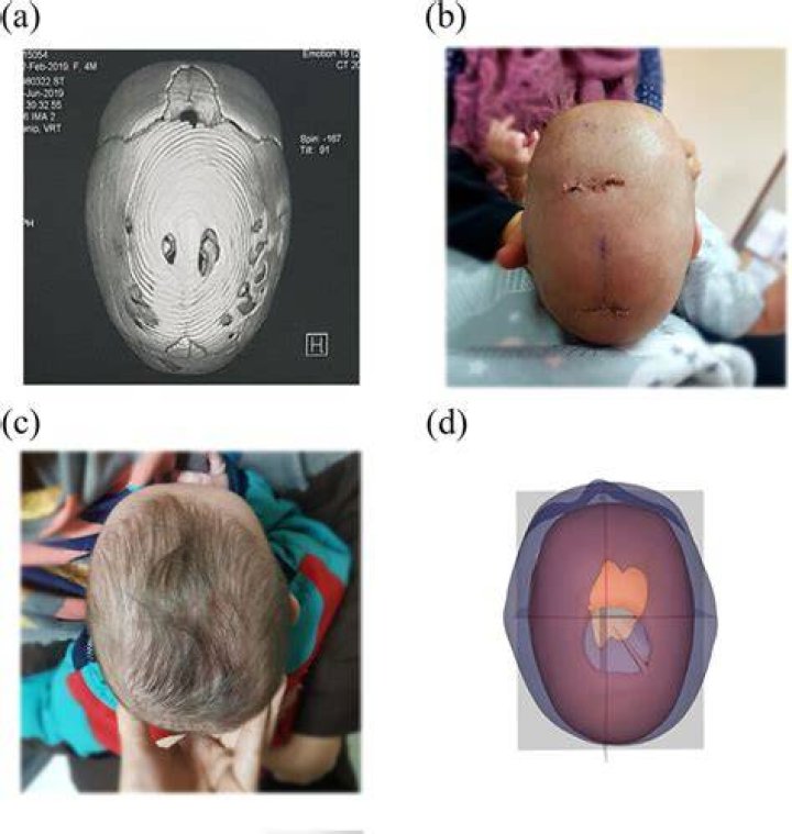 Does craniosynostosis surgery leave scars?