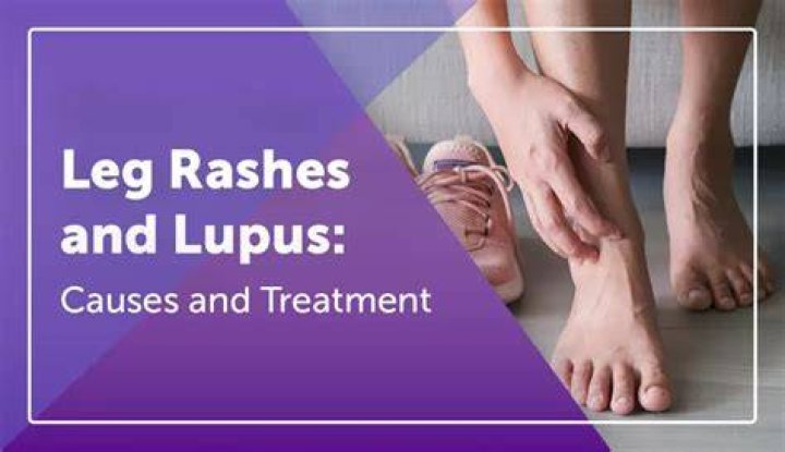 Does lupus cause itchy feet?