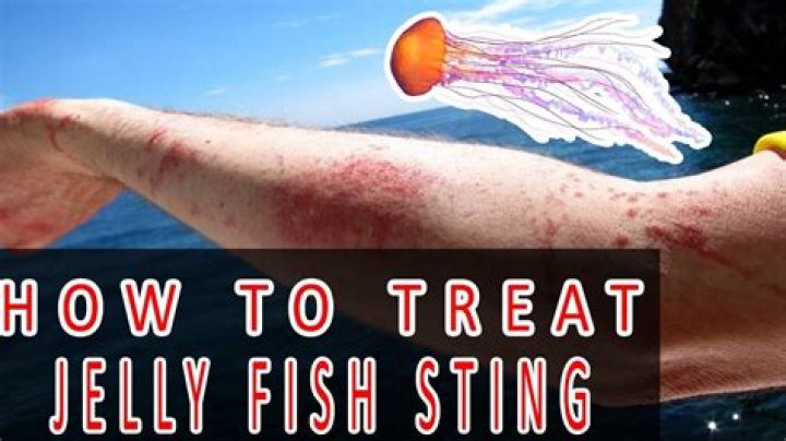 Does Pee help a jellyfish sting?