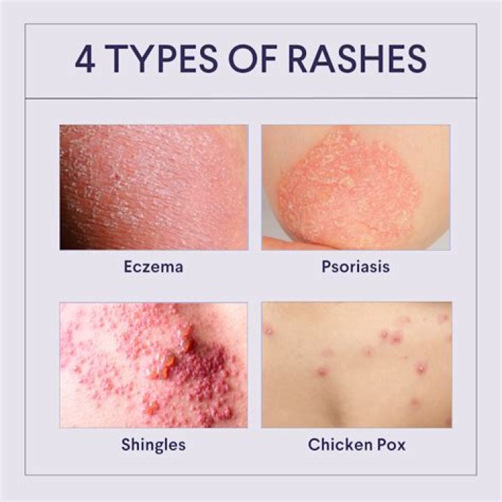 How can you tell if a rash is fungal or bacterial?