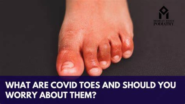 How do COVID toes start?