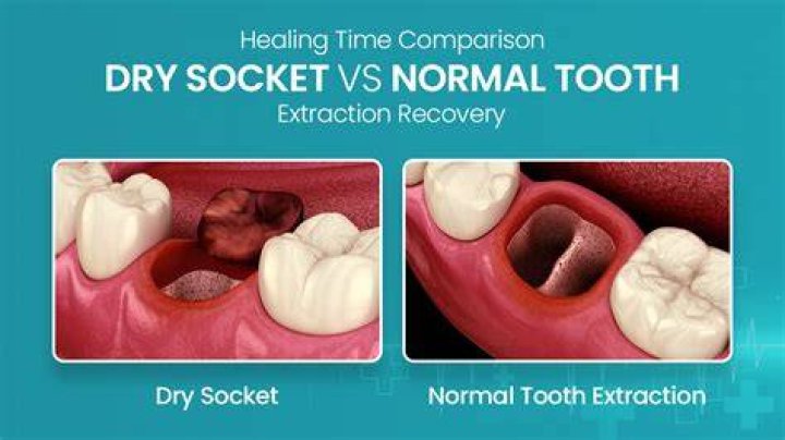 How do dentist treat dry socket?