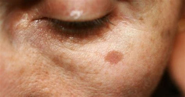How does vitamin E help dark spots?