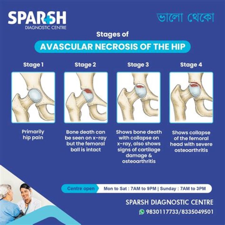 How long does it take for avascular necrosis to develop?