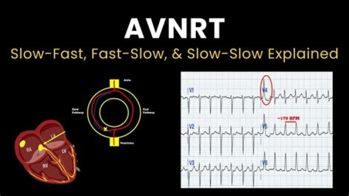 How slow is too slow heart rate?