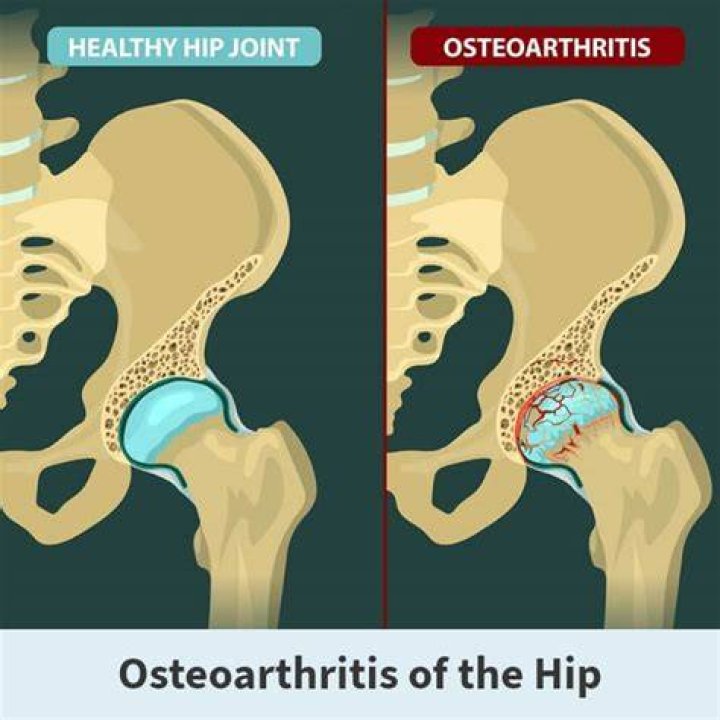 Is walking good if you have arthritis in hip?