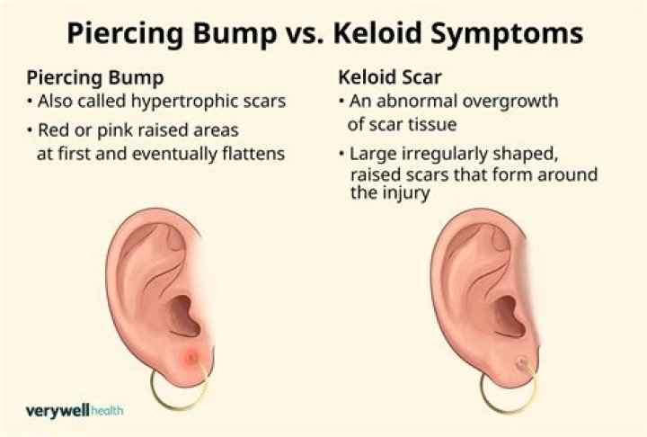 Should you pop a piercing bump?
