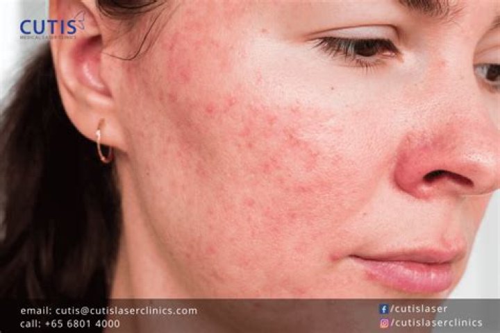 What are little red bumps on my face?