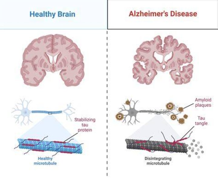 What diseases causes the brain to shrink?