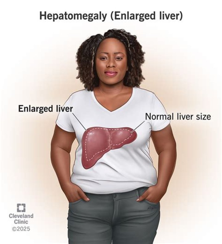 What enlarged liver feels like?