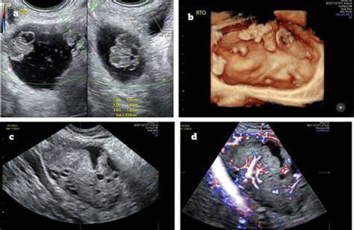 What is a mass on an ultrasound?