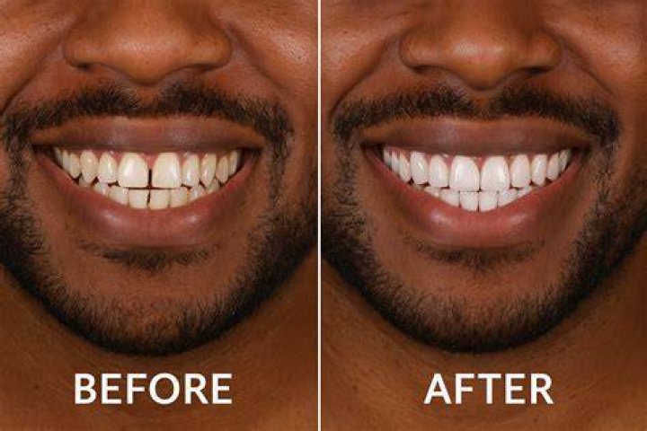 What should I do before getting veneers?