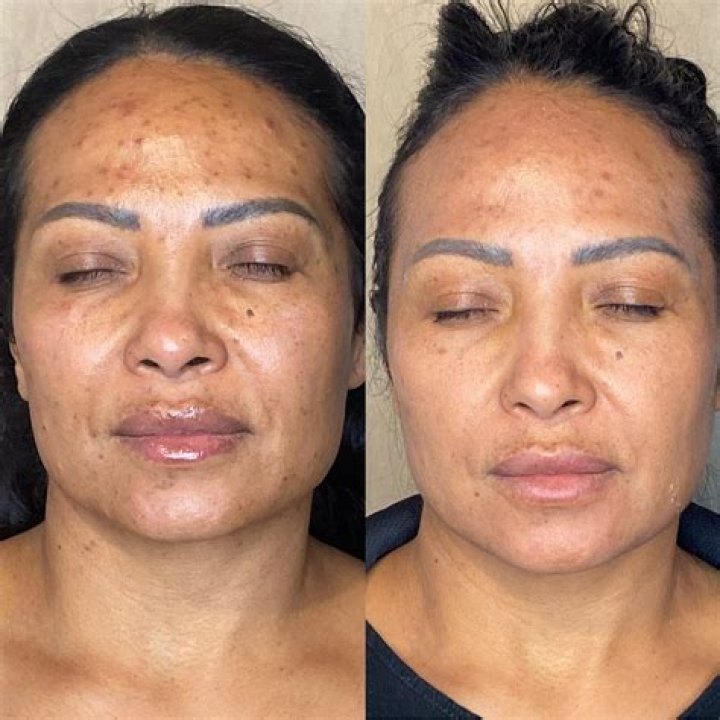 What should I put on my face after microdermabrasion?