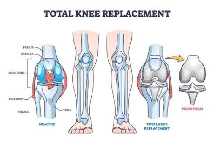 Will a total knee replacement get rid of arthritis?